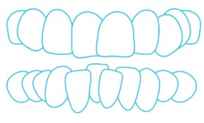 crowded teeth