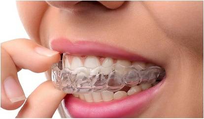 5 Benefits of Invisible Braces or Clear Aligners over Braces