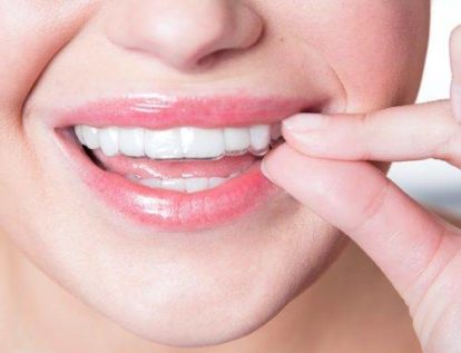 Clear Aligners treatment