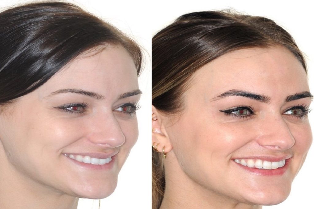 How braces can change the shape of your face