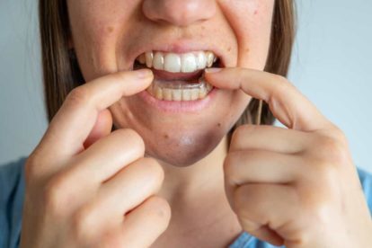 Correcting Crossbite With Clear Aligners