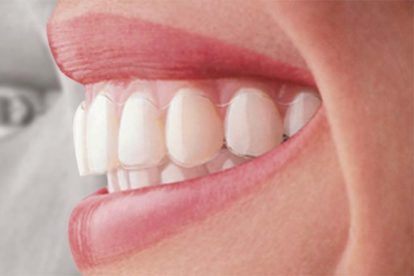clear braces treatment