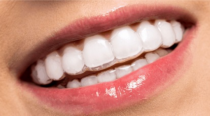 What Are Clear Invisible Aligners or Invisible Braces? - ArchWired