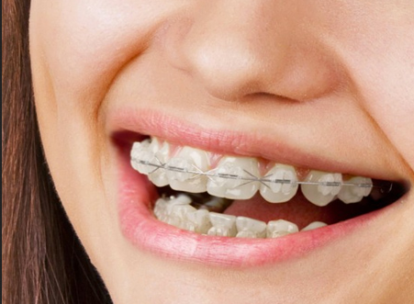 CERAMIC BRACES