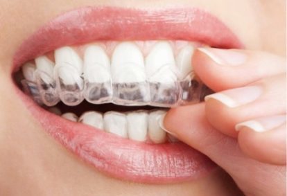 Right Age for Getting Orthodontic Treatment