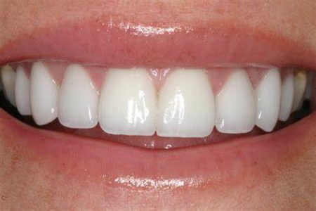 Have Gaps Between Teeth Find How to Close Them Naturally