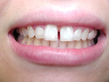 Gaps Between Teeths