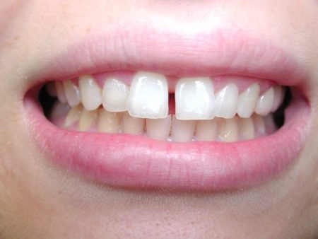 Right Age for Getting Orthodontic Treatment