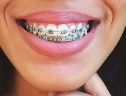 Metallic Braces