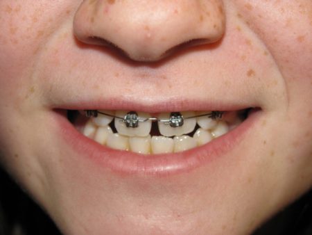 Have Gaps Between Teeth Find How to Close Them Naturally