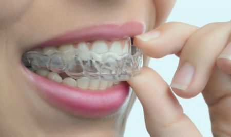Clear Aligners Work