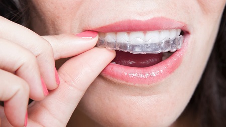 clear aligners for all age