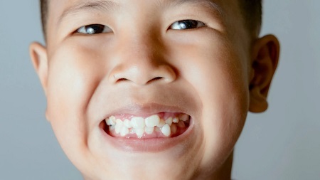 clear aligners for children