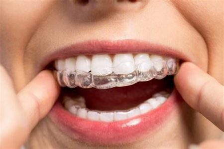 Results with clear aligners