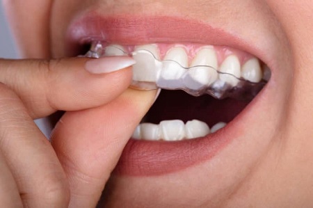 What Does Getting Clear Aligners Involve