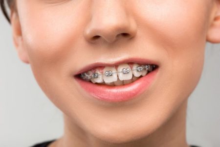 braces for teeth gaps