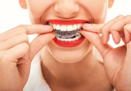 clear aligner treatment