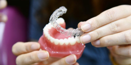 Why Choose SD Align Clear Aligners