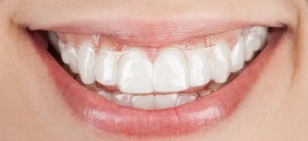 clear aligner smile