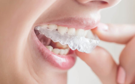 comfortable aligners