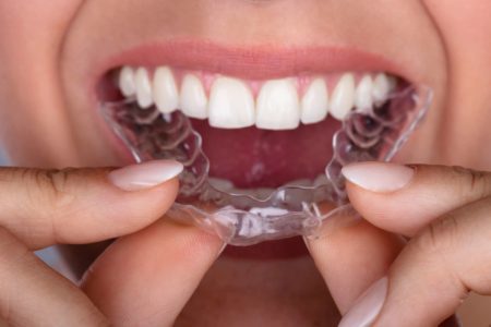 clear aligner costs