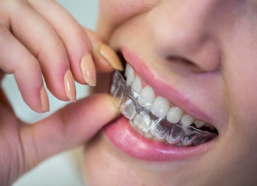 Invisible Braces for Orthodontic Treatment