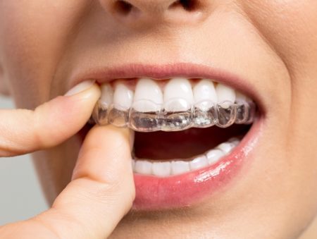 I have an overbite; what causes an overbite? - Orthodontic Society of  Ireland