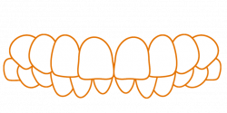 SDalign Deep Bite