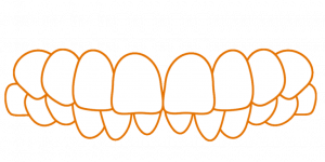 SDalign-Deep-Bite.png SDalign Deep Bite