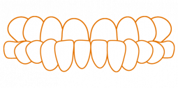 SDalign-Underbite.png SDalign-Underbite.png